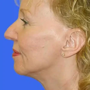 Face Lift before and after photos