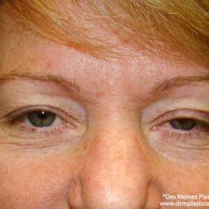 Eyelid Surgery before and after photos