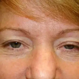 Eyelid Surgery before and after photos