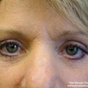 Eyelid Surgery before and after photos