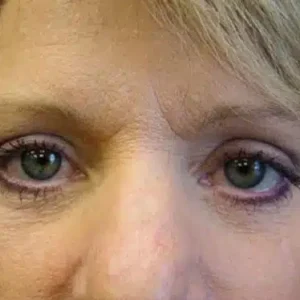 Eyelid Surgery before and after photos