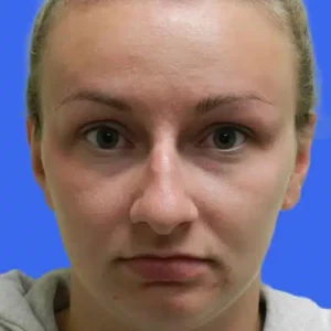 Rhinoplasty before and after photos