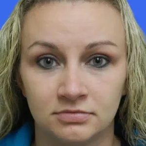 Rhinoplasty before and after photos