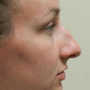 Rhinoplasty before and after photos