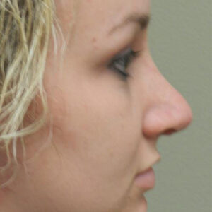 Rhinoplasty before and after photos