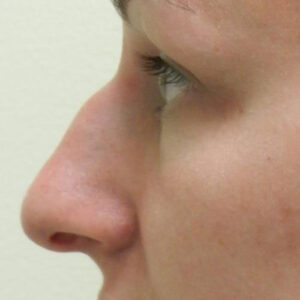 Rhinoplasty before and after photos