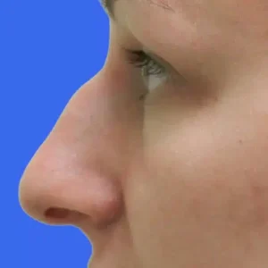 Rhinoplasty before and after photos