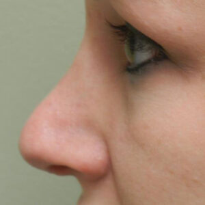 Rhinoplasty before and after photos