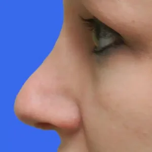 Rhinoplasty before and after photos