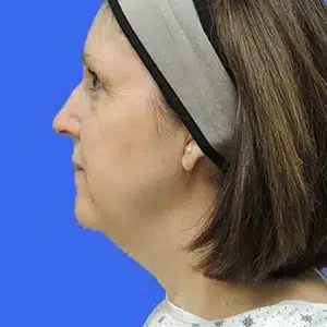 Laser Lift before and after photos