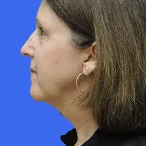 Laser Lift before and after photos