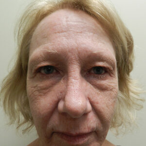 Laser Skin Resurfacing before and after photos