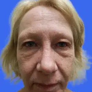 Laser Skin Resurfacing before and after photos