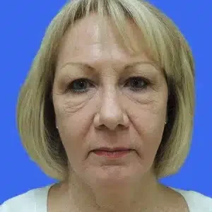 Laser Skin Resurfacing before and after photos