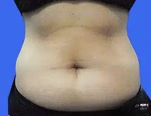 CoolSculpting before and after photos CoolSculpting before and after photos