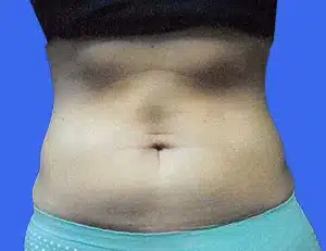 CoolSculpting before and after photos CoolSculpting before and after photos