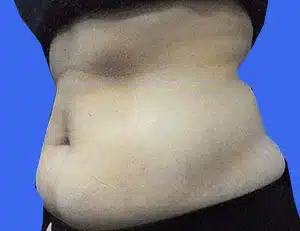 CoolSculpting before and after photos CoolSculpting before and after photos