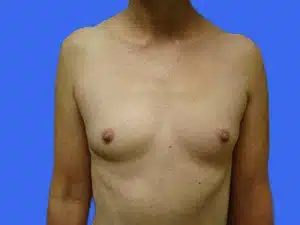 Breast Augmentation before and after photos Breast Augmentation before and after photos
