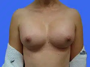 Breast Augmentation before and after photos Breast Augmentation before and after photos