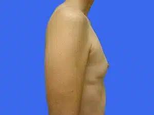 Breast Augmentation before and after photos Breast Augmentation before and after photos