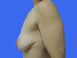 Breast Lift before and after photos Breast Lift before and after photos