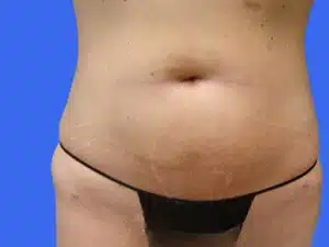 Liposuction before and after photos Liposuction before and after photos