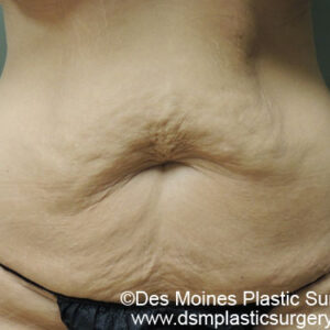 Tummy Tuck before and after photos