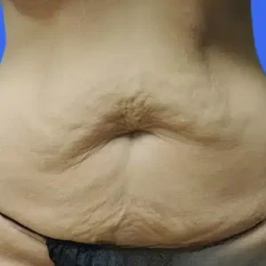 Tummy Tuck before and after photos Tummy Tuck before and after photos