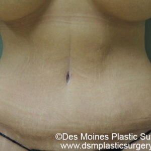 Tummy Tuck before and after photos