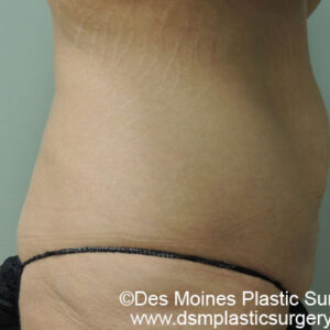 Tummy Tuck before and after photos
