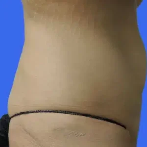Tummy Tuck before and after photos Tummy Tuck before and after photos
