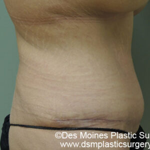 Tummy Tuck before and after photos
