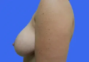 Breast Lift before and after photos Breast Lift before and after photos