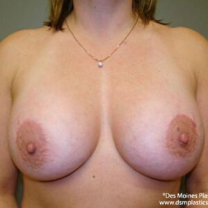 Breast Lift with Augmentation before and after photos