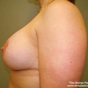 Breast Lift with Augmentation before and after photos