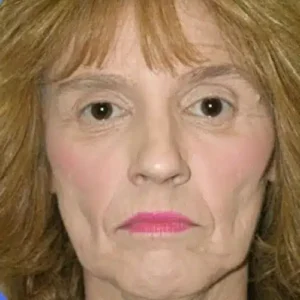 Face Lift before and after photos