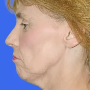 Face Lift before and after photos