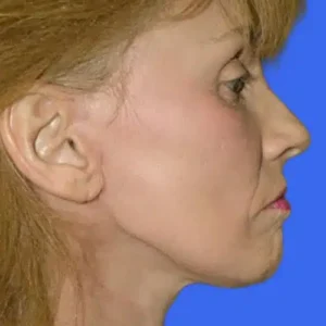 Face Lift before and after photos