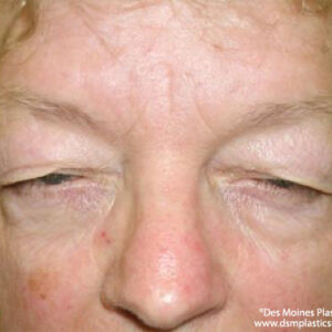 Eyelid Surgery before and after photos