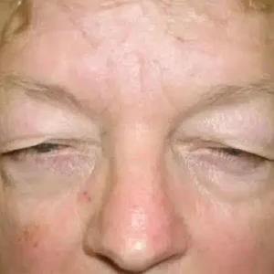 Eyelid Surgery before and after photos