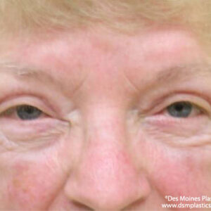 Eyelid Surgery before and after photos