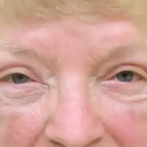 Eyelid Surgery before and after photos