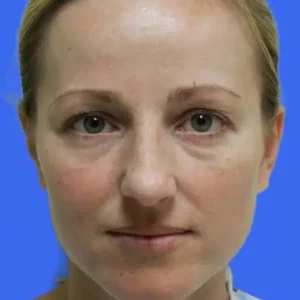 Rhinoplasty before and after photos