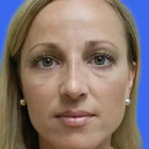 Rhinoplasty before and after photos