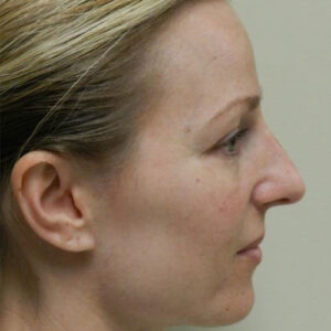 Rhinoplasty before and after photos