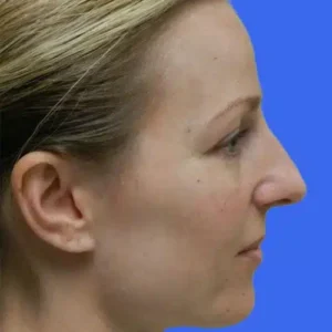 Rhinoplasty before and after photos