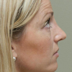 Rhinoplasty before and after photos