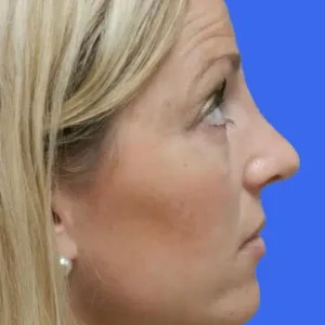 Rhinoplasty before and after photos