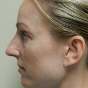 Rhinoplasty before and after photos