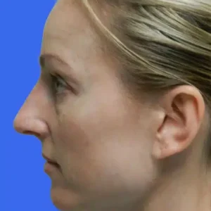 Rhinoplasty before and after photos